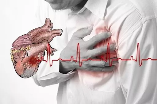 Rối loạn nhịp tim có thể gây biến chứng suy tim.webp